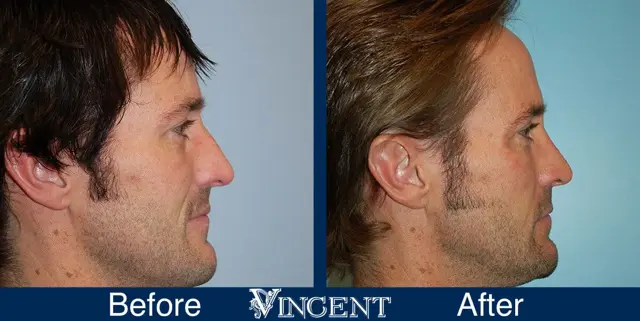 Rhinoplasty result at Vincent Surgical Arts in Cottonwood Heights, UT