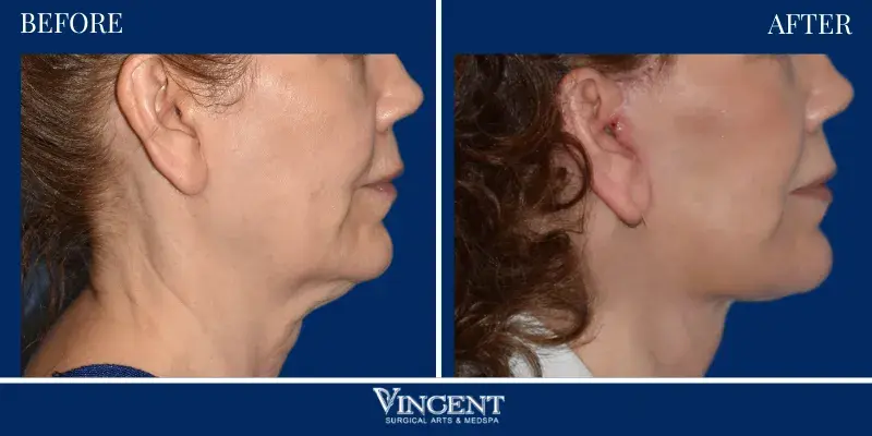 Vincent Surgical Arts facelift result — Cottonwood Heights, UT