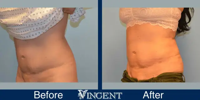 Liposuction result at Vincent Surgical Arts in Cottonwood Heights, UT