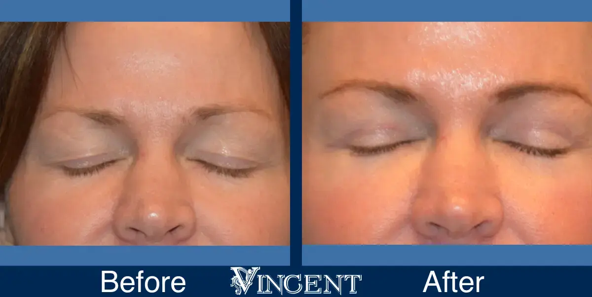 Vincent Surgical Arts blepharoplasty result — Cottonwood Heights, UT