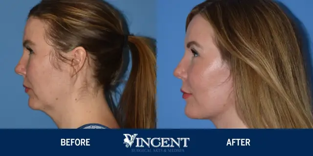 Facelift result at Vincent Surgical Arts in Cottonwood Heights, UT