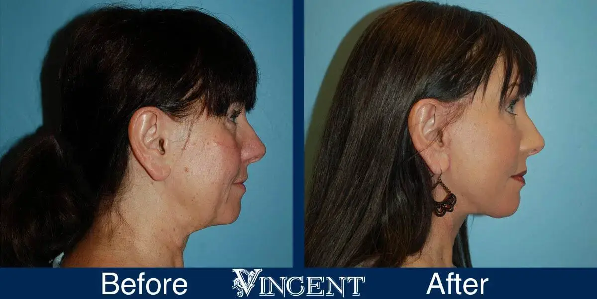 Vincent Surgical Arts facelift result — Cottonwood Heights, UT