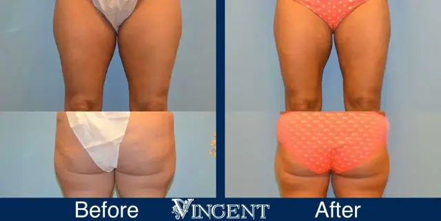 Thigh Lift result at Vincent Surgical Arts in Cottonwood Heights, UT
