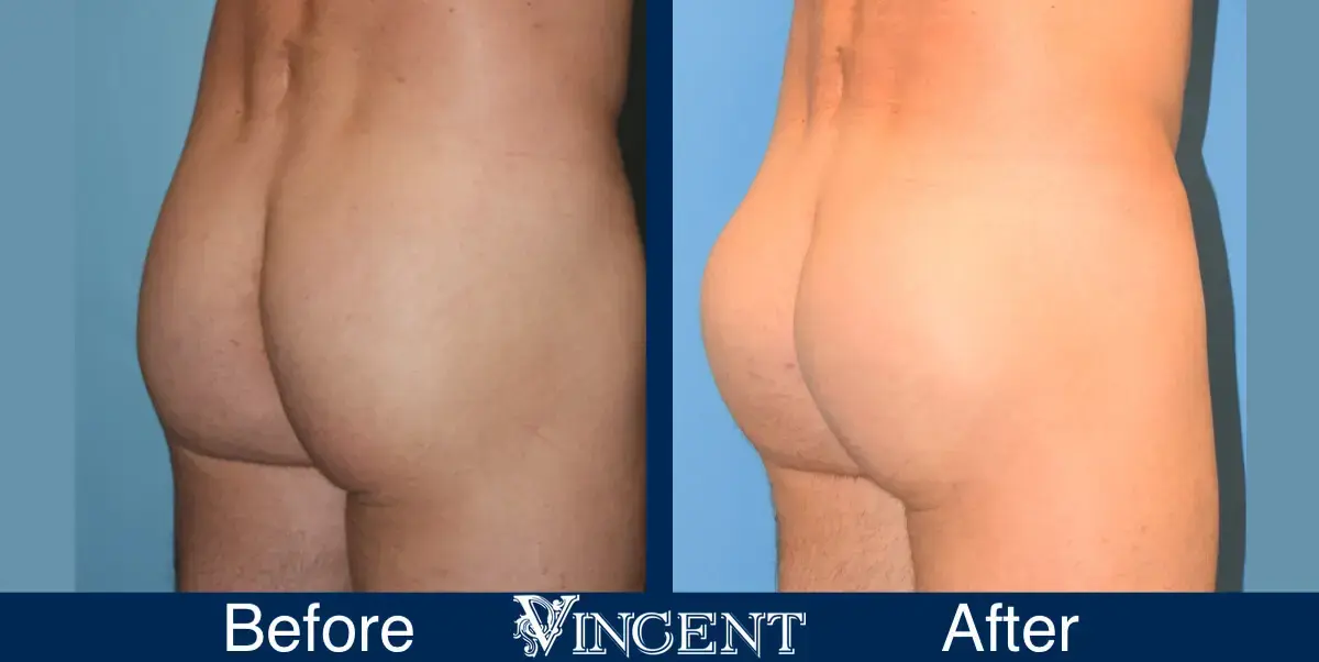 Vincent Surgical Arts bbl result — Cottonwood Heights, UT