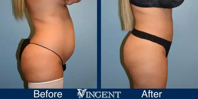 Liposuction result at Vincent Surgical Arts in Cottonwood Heights, UT
