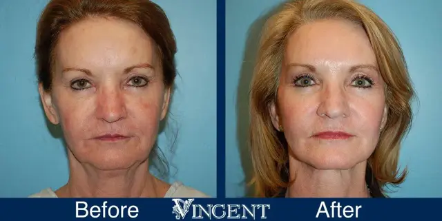 Facelift result at Vincent Surgical Arts in Cottonwood Heights, UT