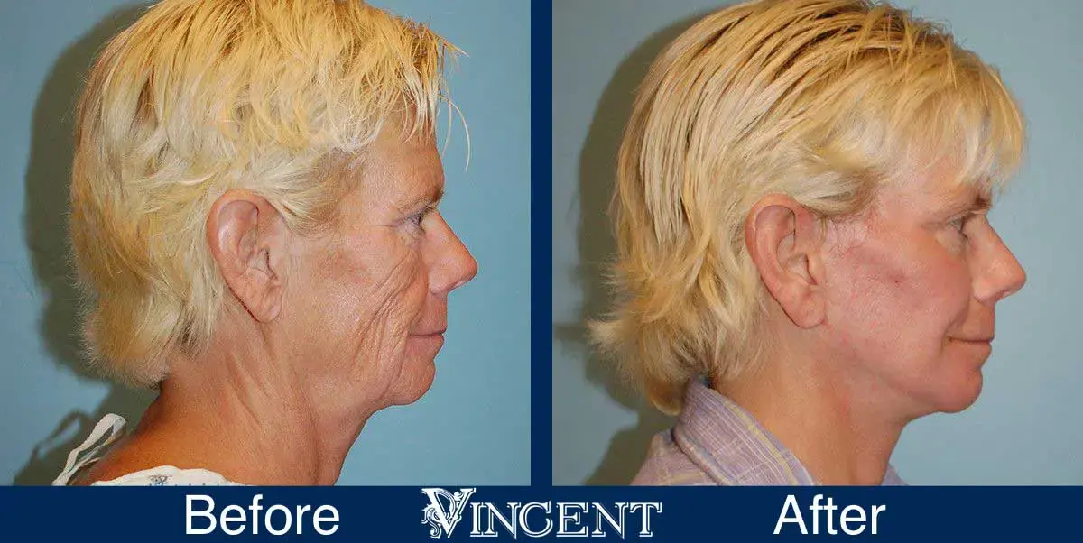Vincent Surgical Arts facelift result — Cottonwood Heights, UT