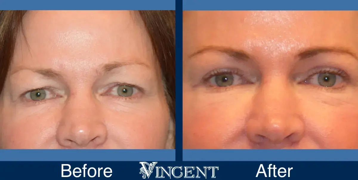 Vincent Surgical Arts blepharoplasty result — Cottonwood Heights, UT