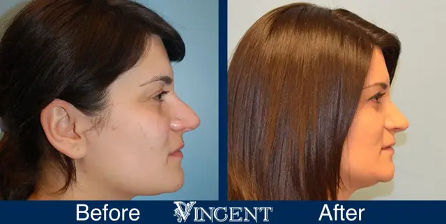 Rhinoplasty result at Vincent Surgical Arts in Cottonwood Heights, UT