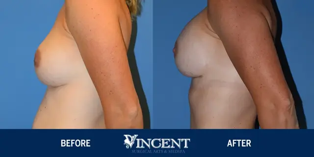 Breast Lift result at Vincent Surgical Arts in Cottonwood Heights, UT