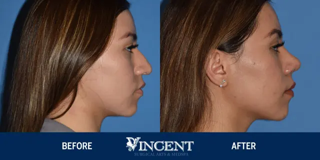 Functional Rhinoplasty result at Vincent Surgical Arts in Cottonwood Heights, UT