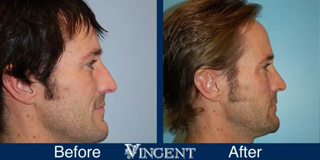Rhinoplasty result at Vincent Surgical Arts in Cottonwood Heights, UT