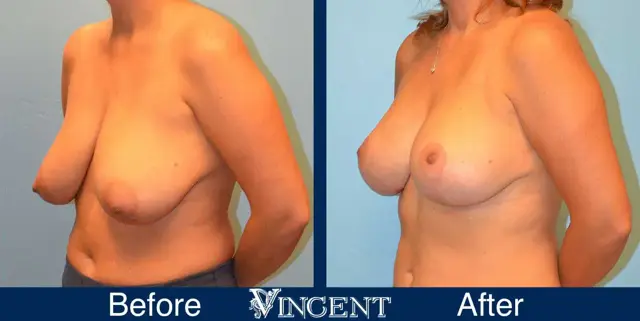 Breast Reduction result at Vincent Surgical Arts in Cottonwood Heights, UT