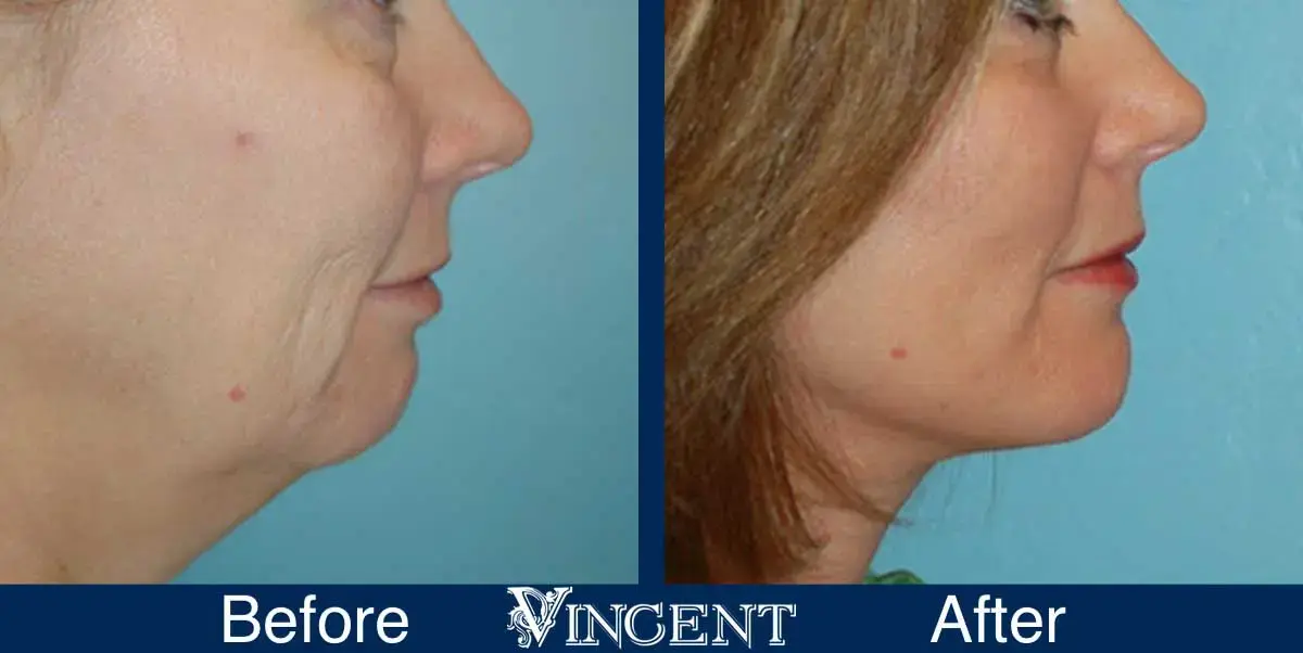 Vincent Surgical Arts facelift result — Cottonwood Heights, UT