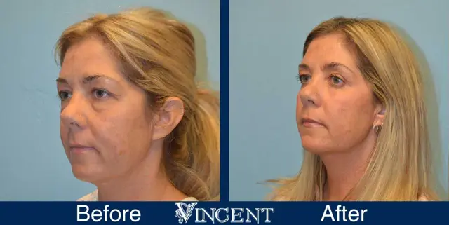 Blepharoplasty result at Vincent Surgical Arts in Cottonwood Heights, UT