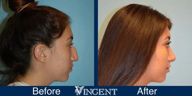 Rhinoplasty result at Vincent Surgical Arts in Cottonwood Heights, UT