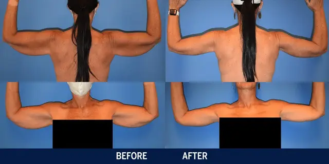Arm Lift result at Vincent Surgical Arts in Cottonwood Heights, UT
