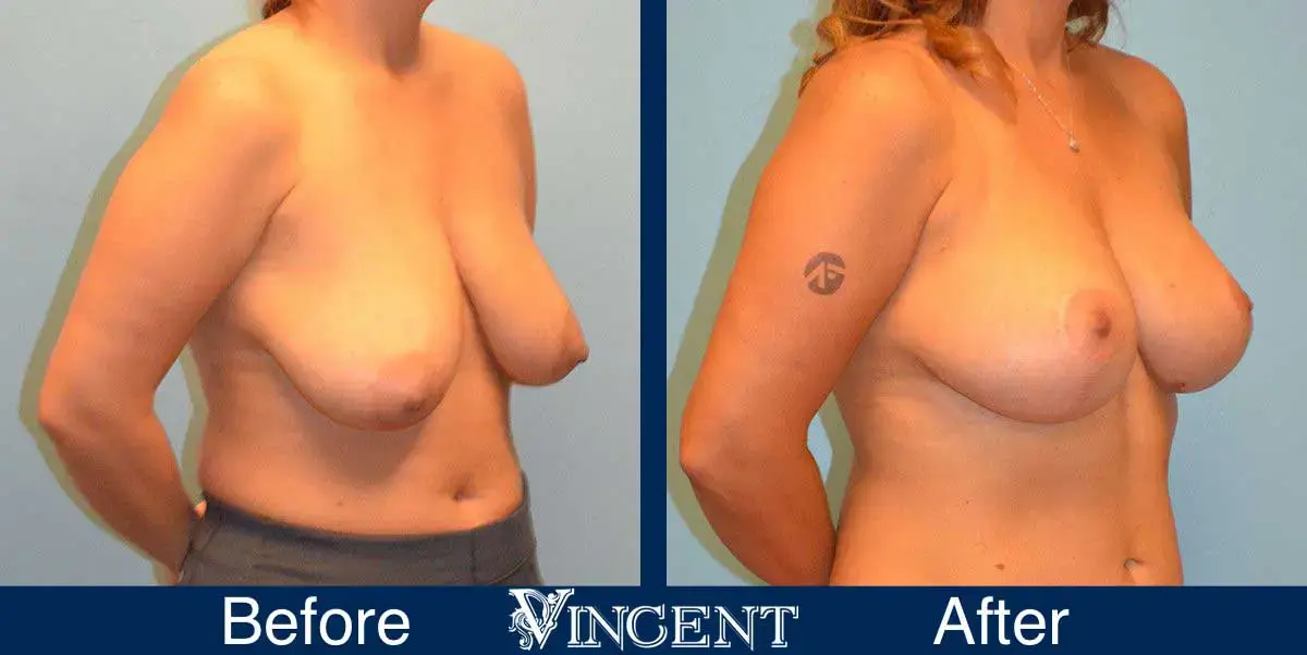 Vincent Surgical Arts breast reduction result — Cottonwood Heights, UT