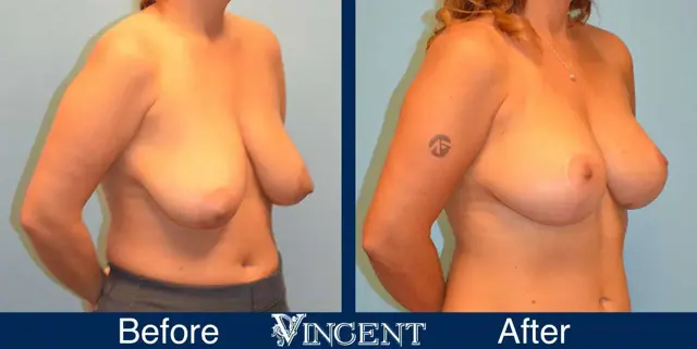 Breast Reduction result at Vincent Surgical Arts in Cottonwood Heights, UT