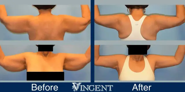 Arm Lift result at Vincent Surgical Arts in Cottonwood Heights, UT