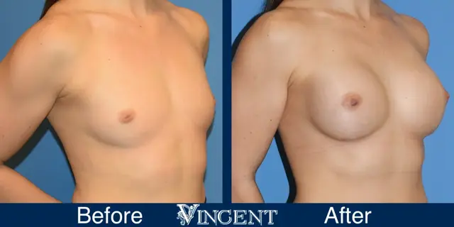 Breast Augmentation result at Vincent Surgical Arts in Cottonwood Heights, UT