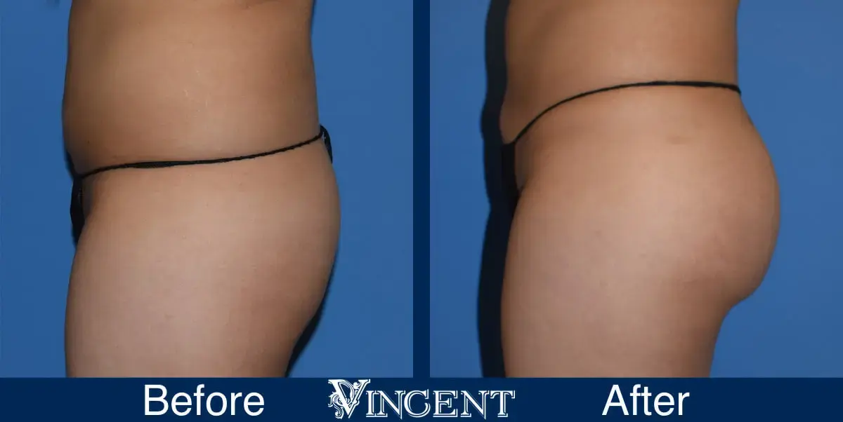 Vincent Surgical Arts bbl result — Cottonwood Heights, UT