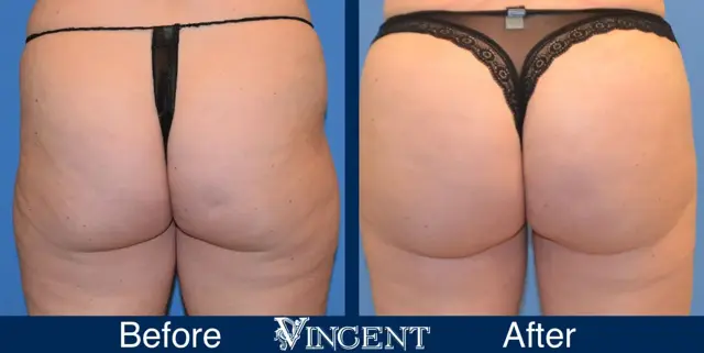 Brazilian Butt Lift result at Vincent Surgical Arts in Cottonwood Heights, UT