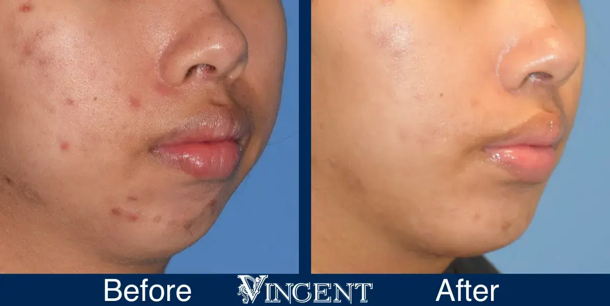 Vincent Surgical Arts chin implant result — Cottonwood Heights, UT