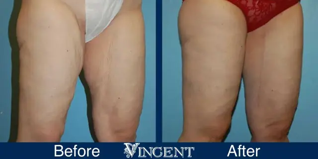 Thigh Lift result at Vincent Surgical Arts in Cottonwood Heights, UT