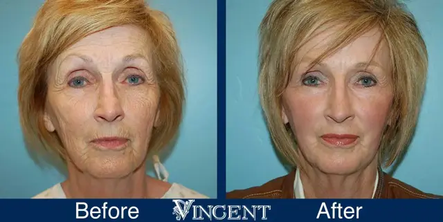 Laser Skin Resurfacing result at Vincent Surgical Arts in Cottonwood Heights, UT