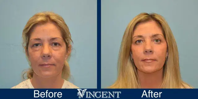 Laser Skin Resurfacing result at Vincent Surgical Arts in Cottonwood Heights, UT