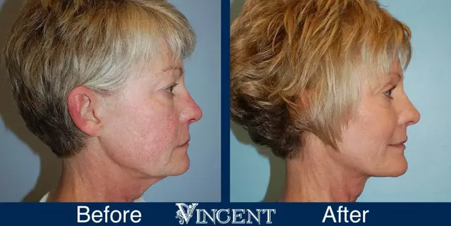 Facelift result at Vincent Surgical Arts in Cottonwood Heights, UT