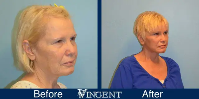 Brow Lift result at Vincent Surgical Arts in Cottonwood Heights, UT