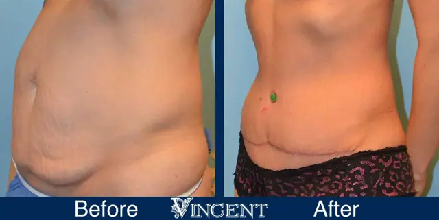 Liposuction result at Vincent Surgical Arts in Cottonwood Heights, UT
