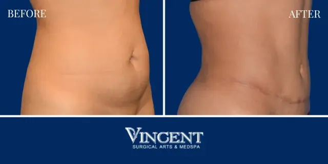 Tummy Tuck result at Vincent Surgical Arts in Cottonwood Heights, UT