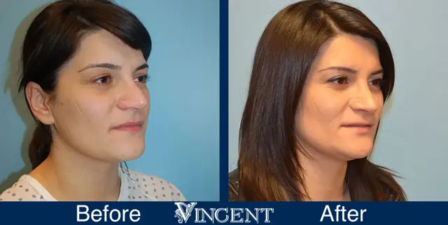 Rhinoplasty result at Vincent Surgical Arts in Cottonwood Heights, UT