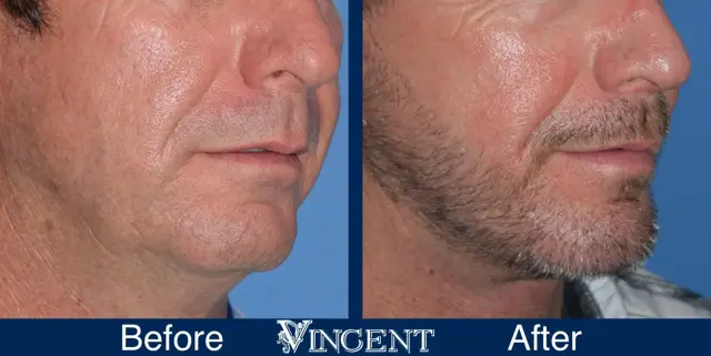 Chin Implant result at Vincent Surgical Arts in Cottonwood Heights, UT