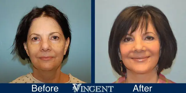 Facelift result at Vincent Surgical Arts in Cottonwood Heights, UT