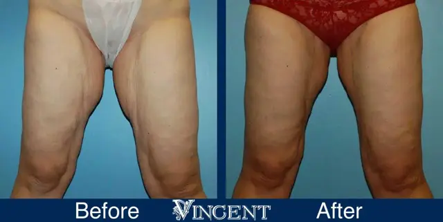 Thigh Lift result at Vincent Surgical Arts in Cottonwood Heights, UT