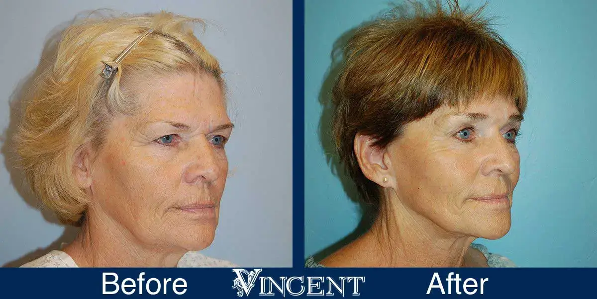 Vincent Surgical Arts brow lift result — Cottonwood Heights, UT
