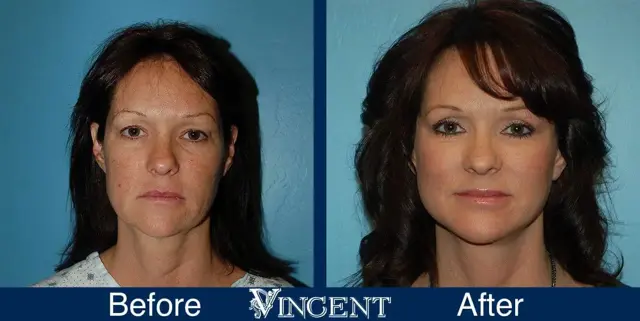 Facelift result at Vincent Surgical Arts in Cottonwood Heights, UT