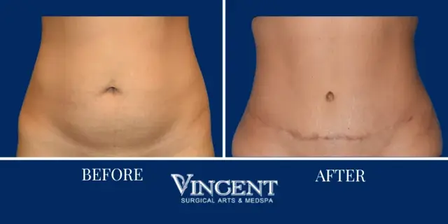 Tummy Tuck result at Vincent Surgical Arts in Cottonwood Heights, UT