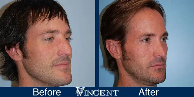 Rhinoplasty result at Vincent Surgical Arts in Cottonwood Heights, UT