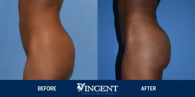 Brazilian Butt Lift result at Vincent Surgical Arts in Cottonwood Heights, UT