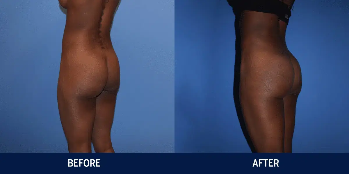 Vincent Surgical Arts bbl result — Cottonwood Heights, UT