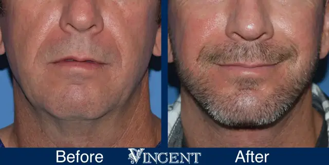Chin Implant result at Vincent Surgical Arts in Cottonwood Heights, UT