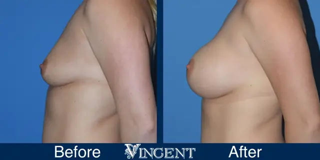 Breast Augmentation result at Vincent Surgical Arts in Cottonwood Heights, UT