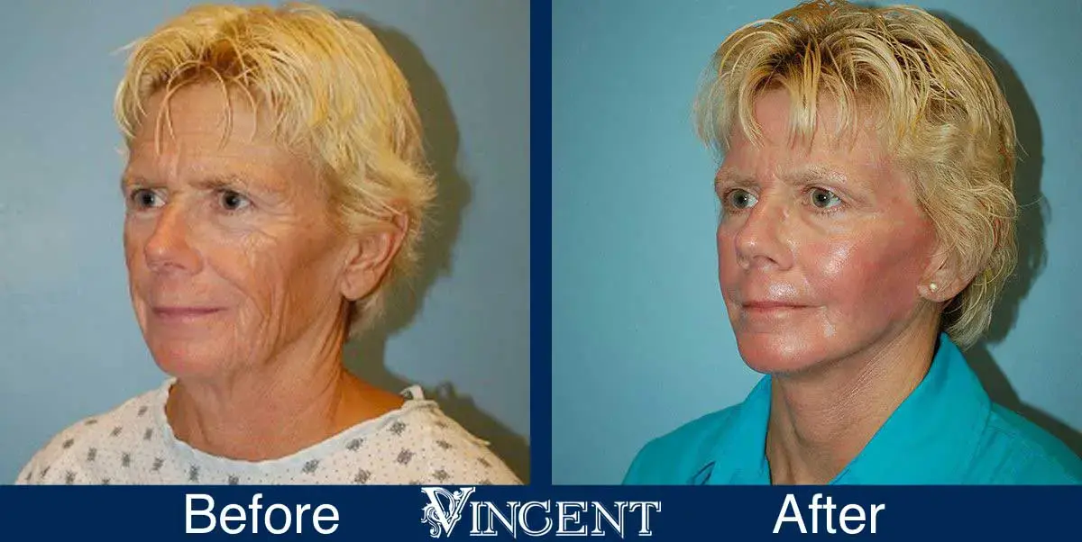 Vincent Surgical Arts fat transfer result — Cottonwood Heights, UT