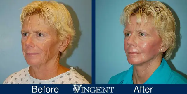 Fat Transfer result at Vincent Surgical Arts in Cottonwood Heights, UT