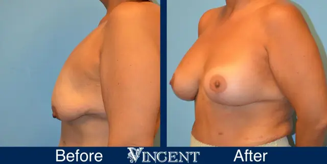 Breast Lift result at Vincent Surgical Arts in Cottonwood Heights, UT